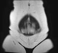 Adenomyosis - ovarian endometriomas (Radiopaedia 67031-76350 Coronal T2 1).jpg