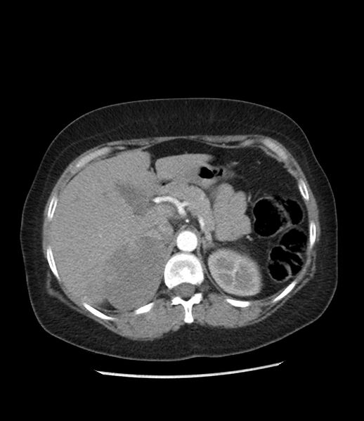 File:Adrenal cortical carcinoma with IVC invasion and thrombosis (Radiopaedia 34307-35597 Axial C+ arterial phase 25).jpg