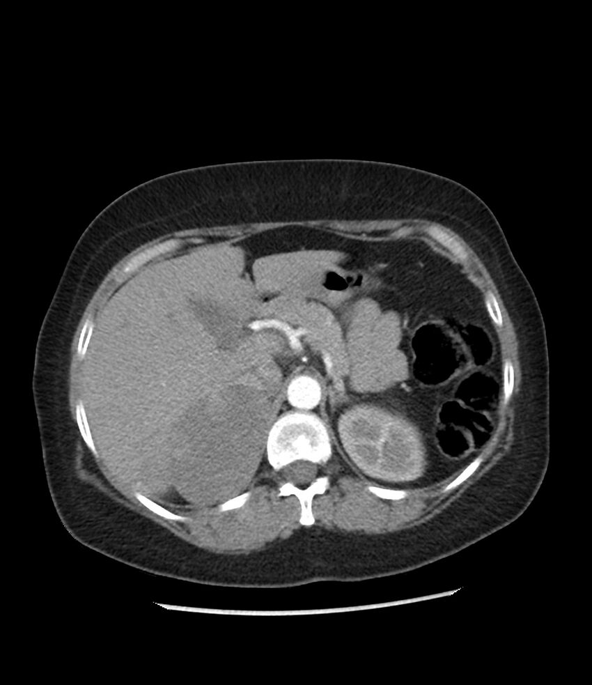 Adrenal cortical carcinoma with IVC invasion and thrombosis (Radiopaedia 34307-35597 Axial C+ arterial phase 25).jpg