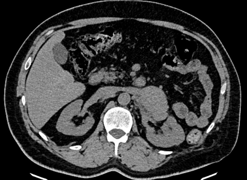 File:Adrenal metastases (Radiopaedia 73082-83791 Axial non-contrast 69).jpg