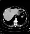 Adrenal myelolipoma (Radiopaedia 6765-7960 Axial C+ arterial phase 2).jpg