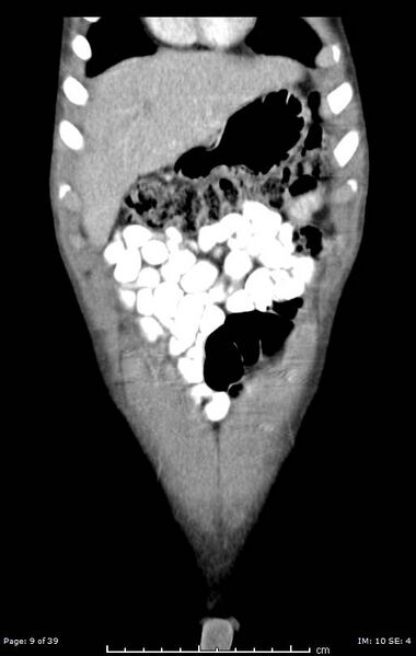 File:Agenesis of the gallbladder (Radiopaedia 55454-61905 Coronal 23).jpg