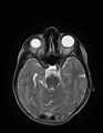 Aicardi syndrome (Radiopaedia 66029-75205 Axial T2 9).jpg
