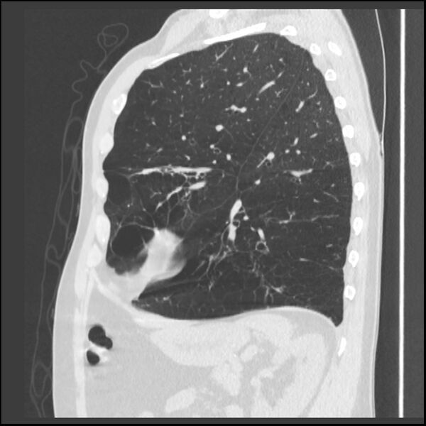 File:Alpha-1-antitrypsin deficiency (Radiopaedia 40993-43722 Sagittal lung window 81).jpg