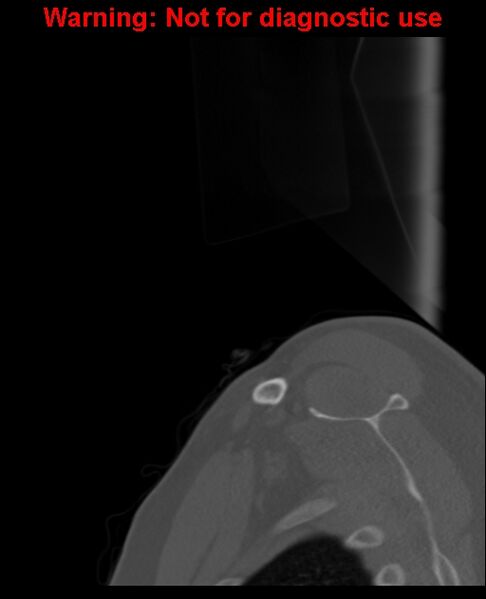 File:Ameloblastoma (Radiopaedia 33126-34164 Sagittal bone window 3).jpg