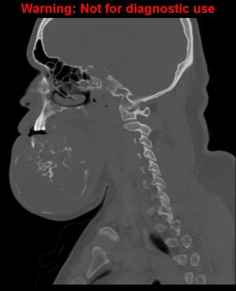 File:Ameloblastoma (Radiopaedia 33126-34164 Sagittal bone window 35).jpg