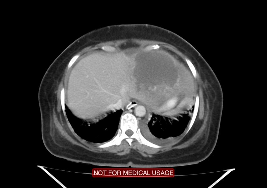 Amoebic enterocolitis with liver abscess (Radiopaedia 35100-36609 A 11).jpg