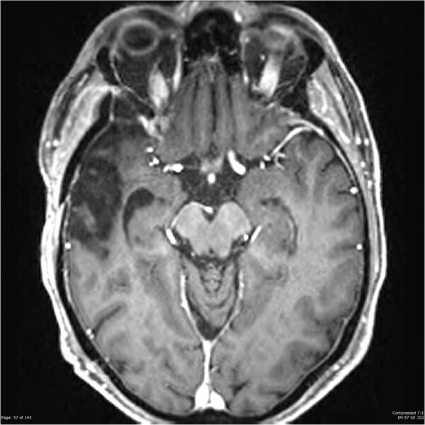 File:Anaplastic meningioma with recurrence (Radiopaedia 34452-35788 Axial T1 C+ 57).jpg