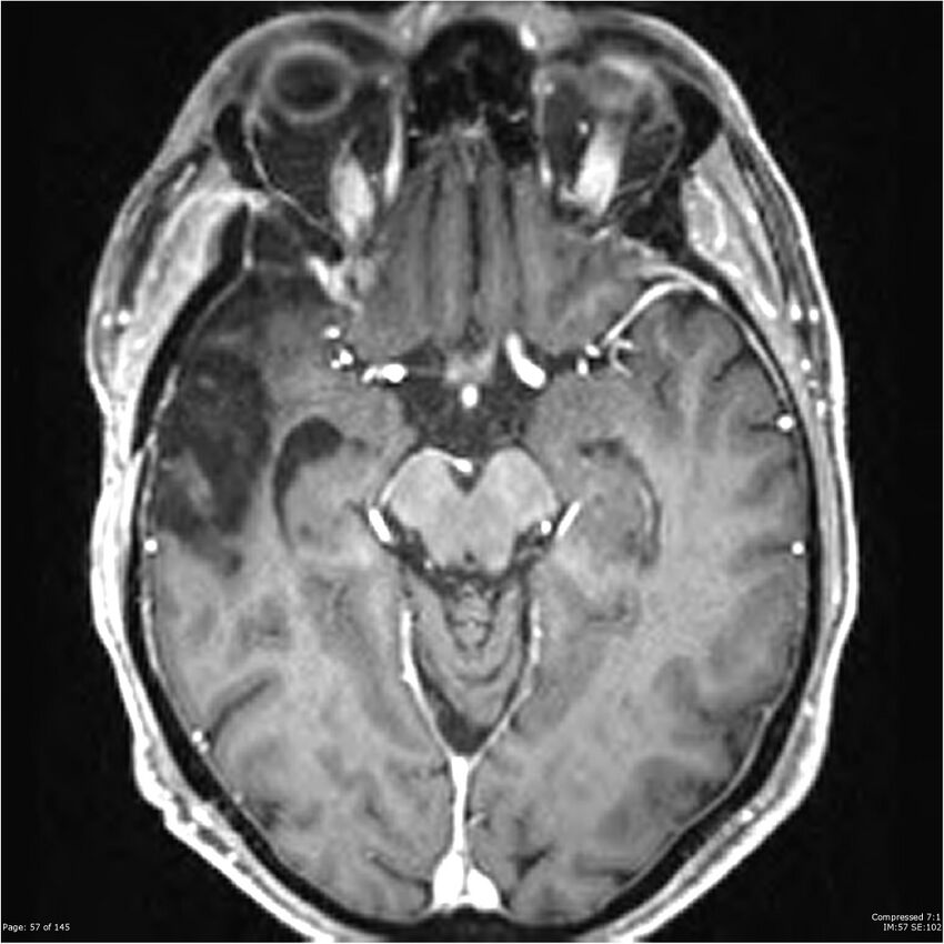 Anaplastic meningioma with recurrence (Radiopaedia 34452-35788 Axial T1 C+ 57).jpg