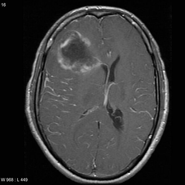 File:Anaplastic oligodendroglioma NOS (hemorrhagic) (Radiopaedia 5418-7169 Axial T1 C+ 6).jpg