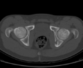 Aneurysmal bone cyst of ischium (Radiopaedia 25957-26094 Axial bone window 61).png