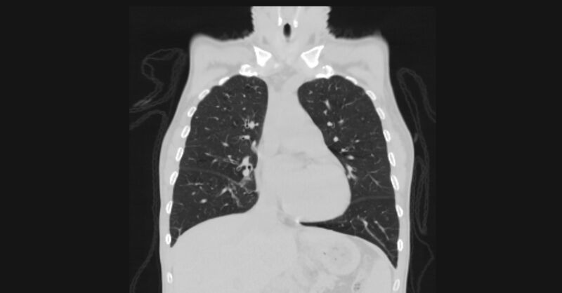 File:Angioinvasive aspergellosis (Radiopaedia 66995-76315 Coronal lung window 25).jpg
