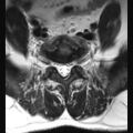 Ankylosing spondylitis with zygapophyseal arthritis (Radiopaedia 38433-40516 Axial T2 3).jpg