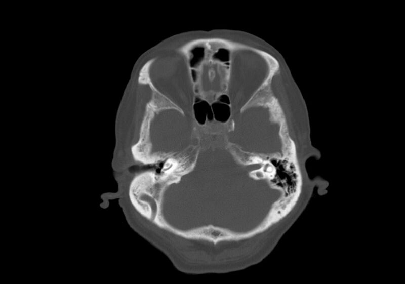 File:Anomalous intracranial venous drainage (Radiopaedia 28161-28418 Axial bone window 8).jpg