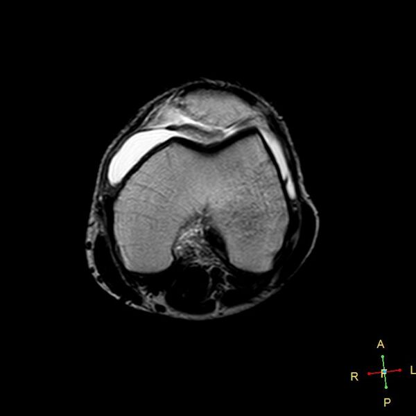 File:Anterior cruciate ligament tear - complete (Radiopaedia 24907-25170 T2 11).jpg