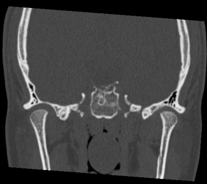 File:Antrochoanal polyp (Radiopaedia 21894-21868 Coronal bone window 34).jpg