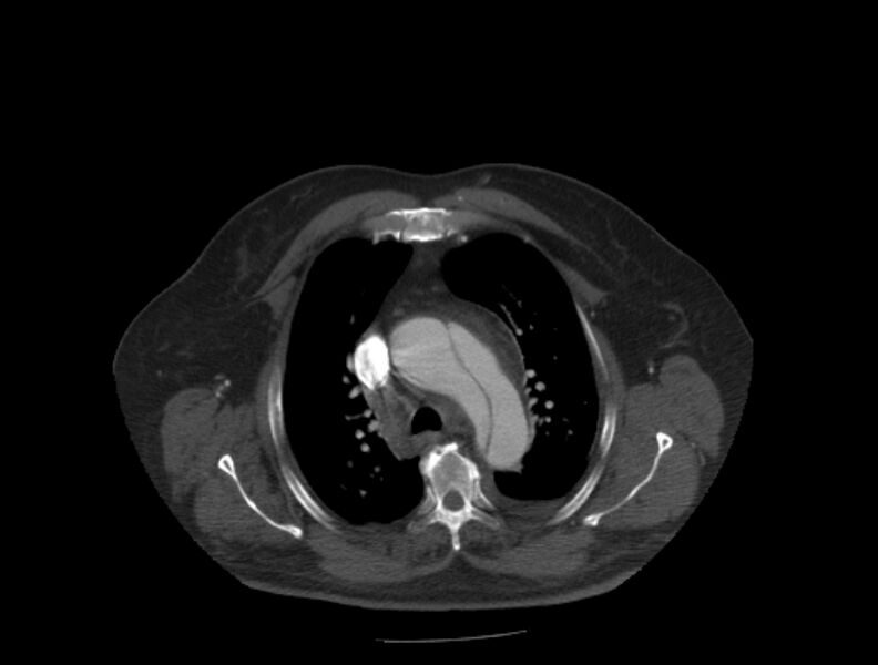 File:Aortic dissection (Radiopaedia 28802-29105 A 9).jpg