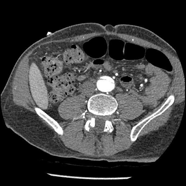 File:Aortic dissection - DeBakey Type I-Stanford A (Radiopaedia 79863-93115 A 61).jpg