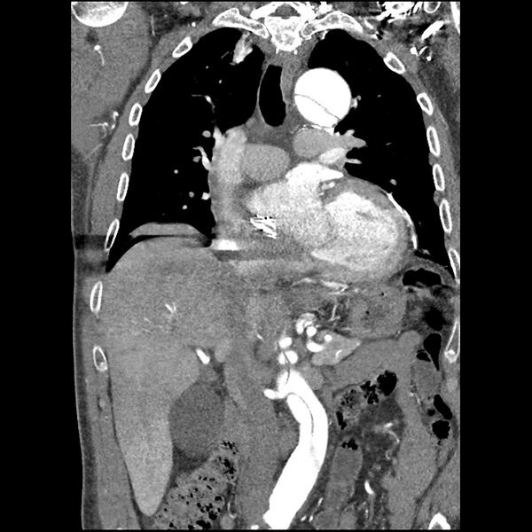 File:Aortic dissection - DeBakey Type I-Stanford A (Radiopaedia 79863-93115 B 18).jpg