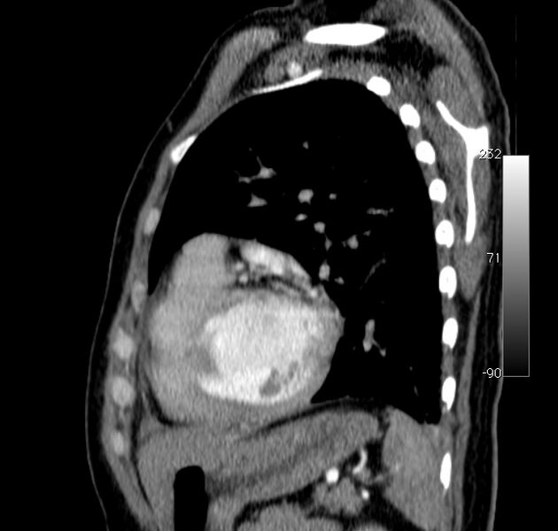 File:Aortic dissection - Stanford type A (Radiopaedia 29247-29659 C 10).jpg