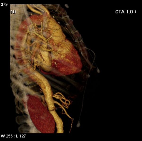 File:Aortic dissection with rupture into pericardium (Radiopaedia 12384-12647 C+ arterial phase 11).jpg