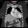 Aortic valve stenosis (Radiopaedia 14480-14423 A 1).jpg