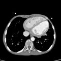Aortopulmonary window, interrupted aortic arch and large PDA giving the descending aorta (Radiopaedia 35573-37074 B 70).jpg