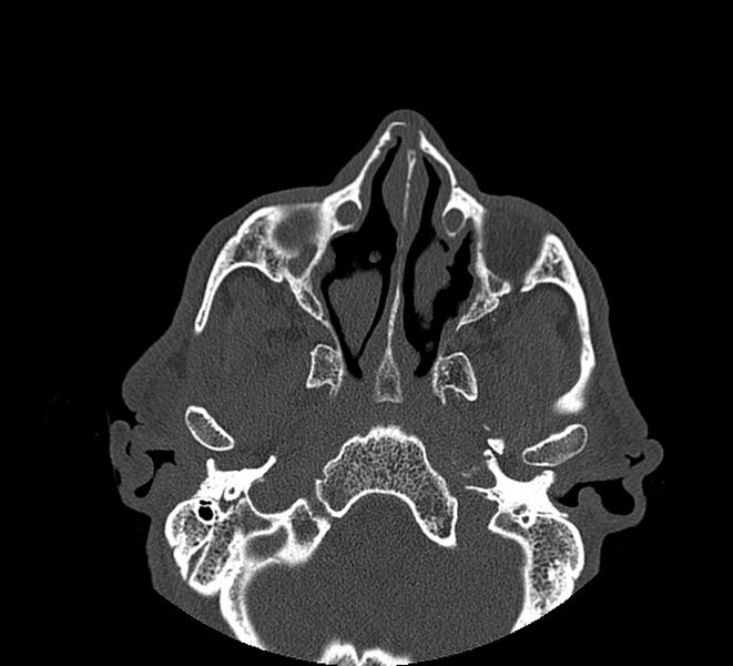 File:Aplastic maxillary sinuses (Radiopaedia 60030-67561 Axial non-contrast 33).jpg