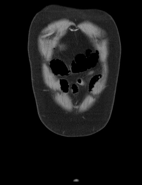 File:Appendicitis and giant appendicolith (Radiopaedia 80251-93588 Coronal non-contrast 3).jpg