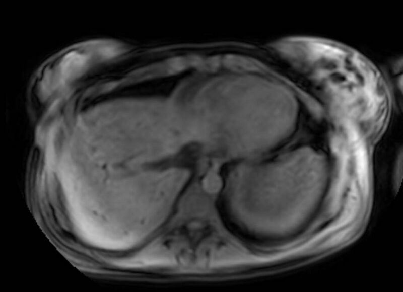 File:Appendicitis in gravida (MRI) (Radiopaedia 89433-106395 Axial DIXON 4).jpg