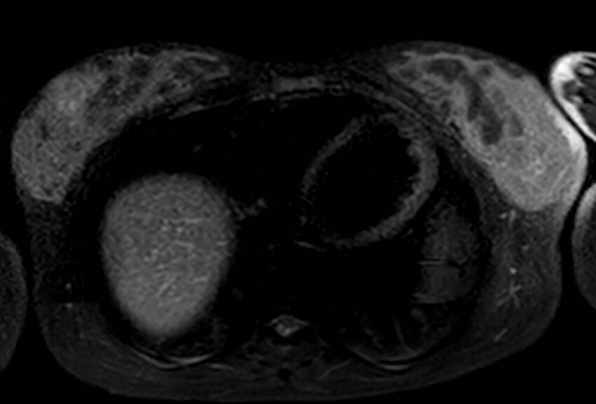 Appendicitis in gravida (MRI) (Radiopaedia 89433-106395 Axial T2 SPAIR 3).jpg