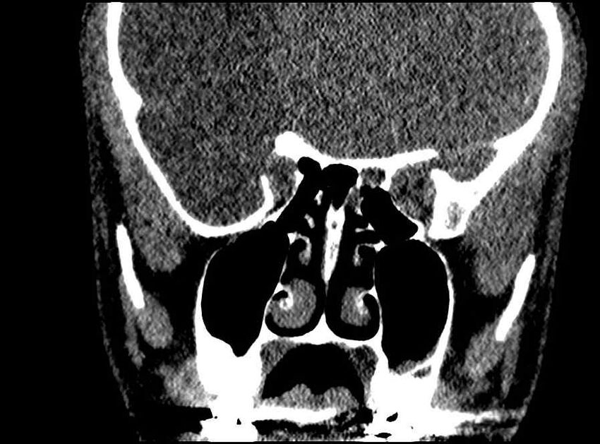 Arachnoid cyst- extremely large (Radiopaedia 68741-78450 Coronal bone window 37).jpg