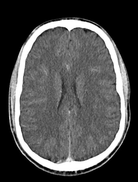 File:Arrow injury to the face (Radiopaedia 73267-84011 Axial C+ delayed 60).jpg