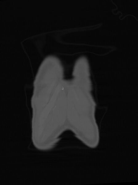 File:Arrow injury to the neck (Radiopaedia 75225-86323 Coronal bone window 9).jpg