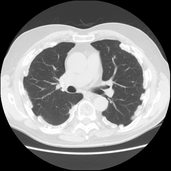 File:Asbestos-related pleural plaques (Radiopaedia 39069-41255 Axial lung window 34).jpg