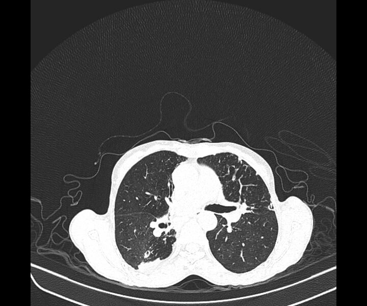 File:Aspergillomas (Radiopaedia 66779-76110 Axial lung window 23).jpg