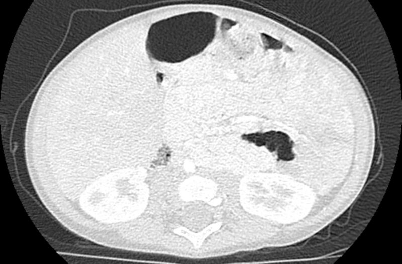 File:Asplenia syndrome (Radiopaedia 73083-83792 Axial lung window 98).jpg