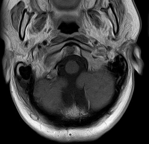 File:Astrocytoma - spinal cord (Radiopaedia 69769-79758 Axial T1 C+ 2).jpg