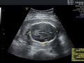Asymmetrical intrauterine growth restriction with fetal distress (Radiopaedia 85176).jpg
