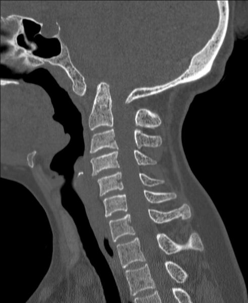 File:Atlanto-occipital assimilation with basilar invagination (Radiopaedia 70122-80188 Sagittal bone window 61).jpg