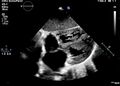 Atrial septal defect with pulmonary hypertension (Radiopaedia 48742-53755 B 1).JPG