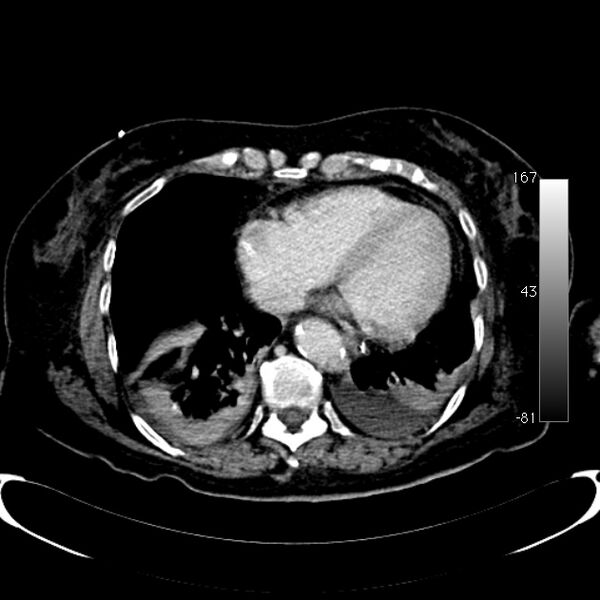 File:Atypical dissection of the thoracic aorta (Radiopaedia 10975-78320 A 50).jpg