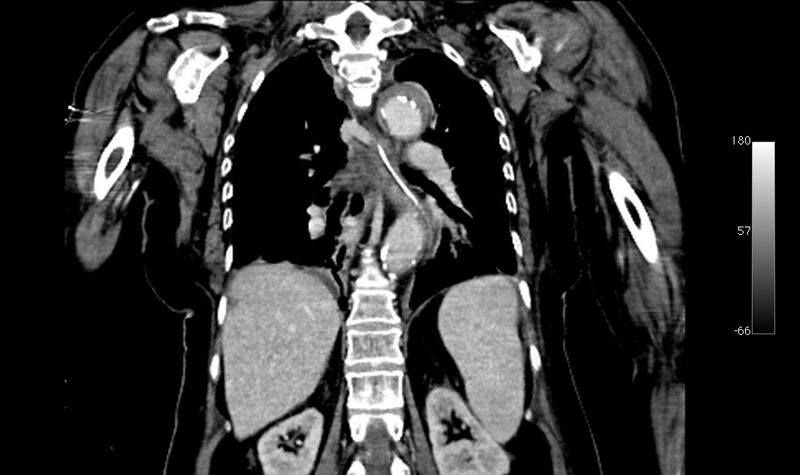 File:Atypical dissection of the thoracic aorta (Radiopaedia 10975-78320 B 29).jpg