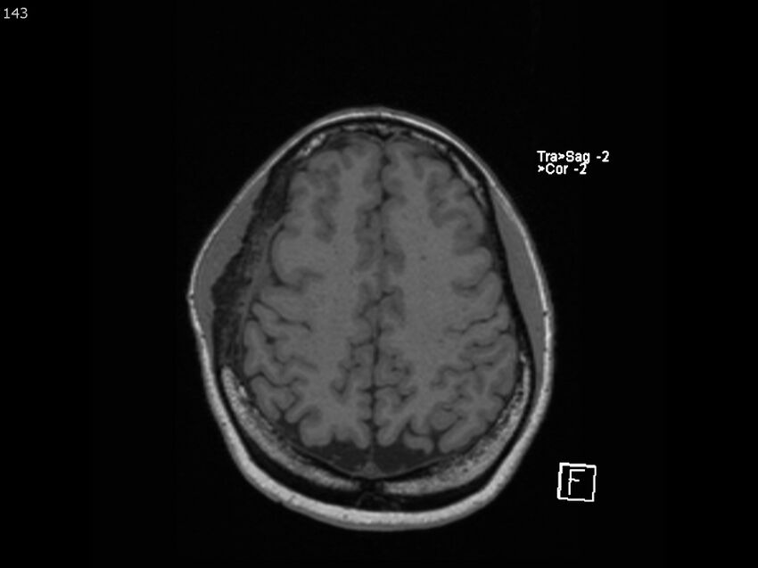 Atypical meningioma - intraosseous (Radiopaedia 64915-74572 Axial T1 143).jpg