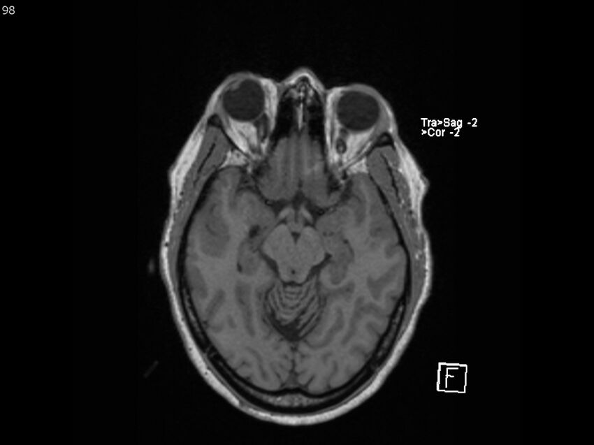 Atypical meningioma - intraosseous (Radiopaedia 64915-74572 Axial T1 98).jpg