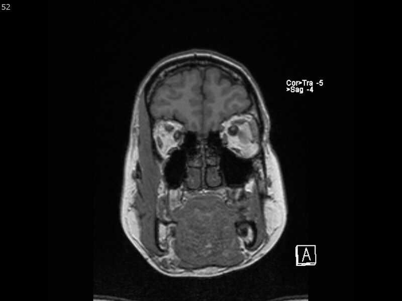 File:Atypical meningioma - intraosseous (Radiopaedia 64915-74572 Coronal T1 52).jpg