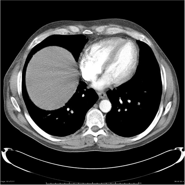 File:Atypical pneumonia - Q fever (Radiopaedia 21993-21989 C+ arterial phase 35).jpg