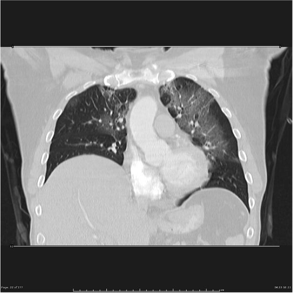 File:Atypical pneumonia - Q fever (Radiopaedia 21993-21989 C 15).jpg