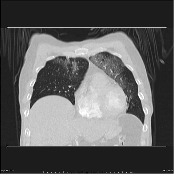 File:Atypical pneumonia - Q fever (Radiopaedia 21993-21989 C 9).jpg