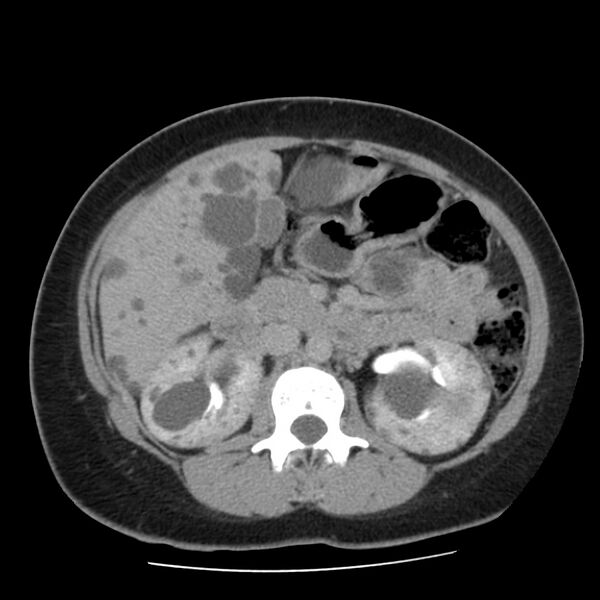 File:Autosomal dominant polycystic kidney disease (Radiopaedia 23061-23093 C+ delayed 28).jpg